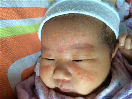 宝宝脸上长湿疹怎么办 几种有效的方法帮你解